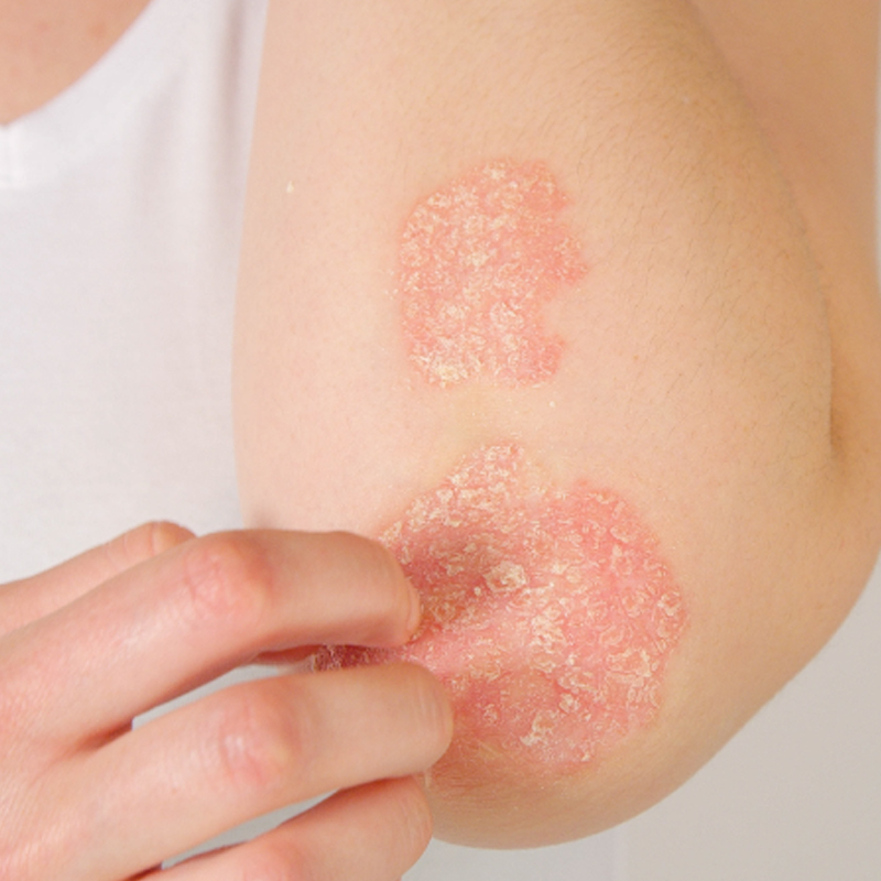 Psoriasis Treatment