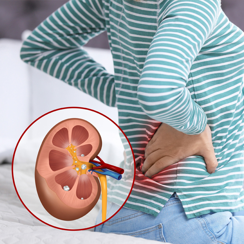 Kidney Stone Prevention