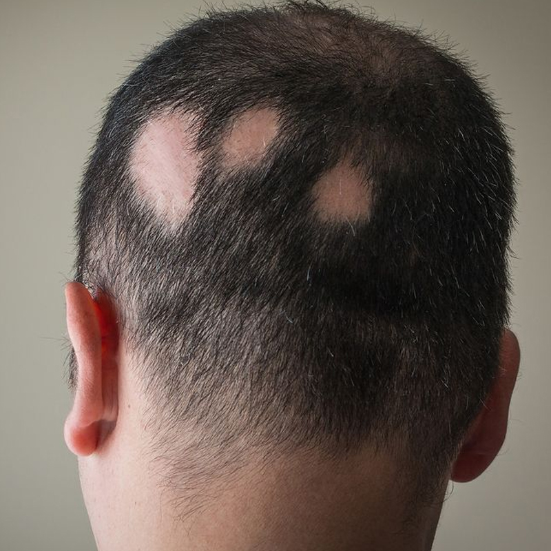 Hair Disorders